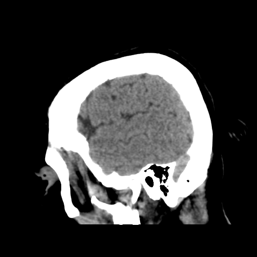 Cerebral metastasis to basal ganglia (Radiopaedia 81568-95412 E 49).png