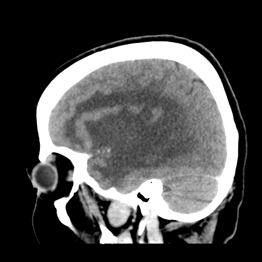 Cerebral metastasis to basal ganglia (Radiopaedia 81568-95412 Sagittal C+ delayed 17).png