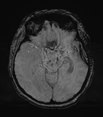 Cerebral metastasis to basal ganglia (Radiopaedia 81568-95413 Axial SWI 34).png