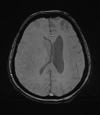 Cerebral metastasis to basal ganglia (Radiopaedia 81568-95413 Axial SWI magnitude 56).png
