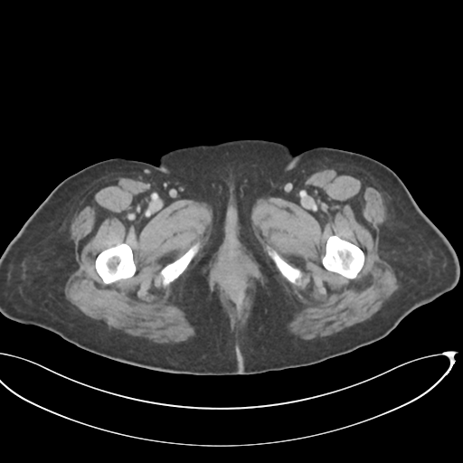 File:Cerebral metastasis to basal ganglia (Radiopaedia 81568-95414 E 84).png