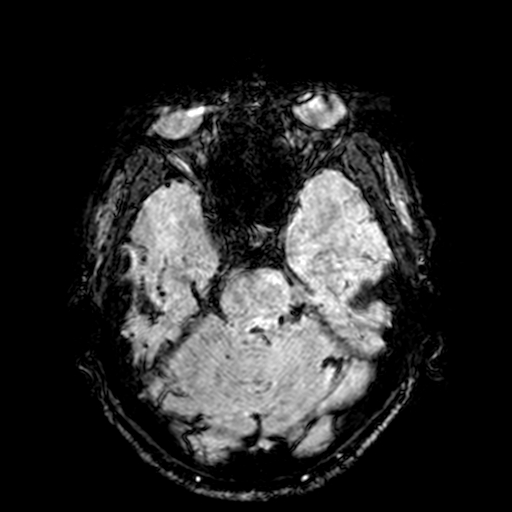 Cerebral parenchymal arteriovenous malformation (Radiopaedia 27280-27456 Axial SWI 28).jpg