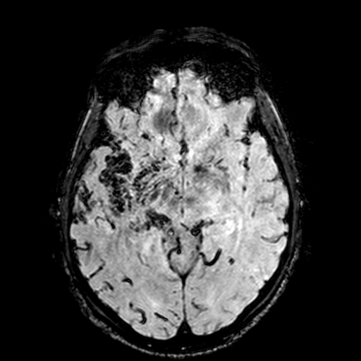Cerebral parenchymal arteriovenous malformation (Radiopaedia 27280-27456 Axial SWI 48).jpg