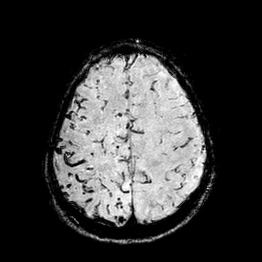 Cerebral parenchymal arteriovenous malformation (Radiopaedia 27280-27456 Axial SWI 95).jpg