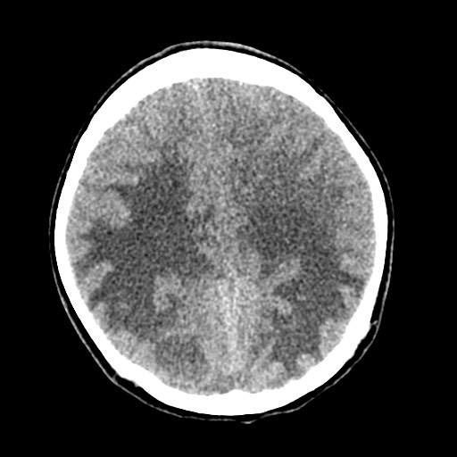 Cerebral tuberculosis with dural sinus invasion (Radiopaedia 60353-68018 Axial non-contrast 40).jpg