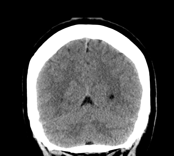 File:Cerebral venous infarct related to dural venous sinus thromboses (Radiopaedia 35292-36804 Coronal non-contrast 28).png