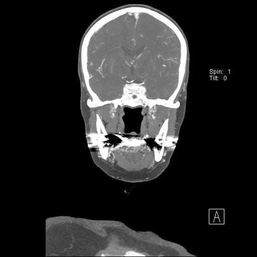 Cerebral venous infarction with hemorrhage (Radiopaedia 65343-74396 B 143).jpg