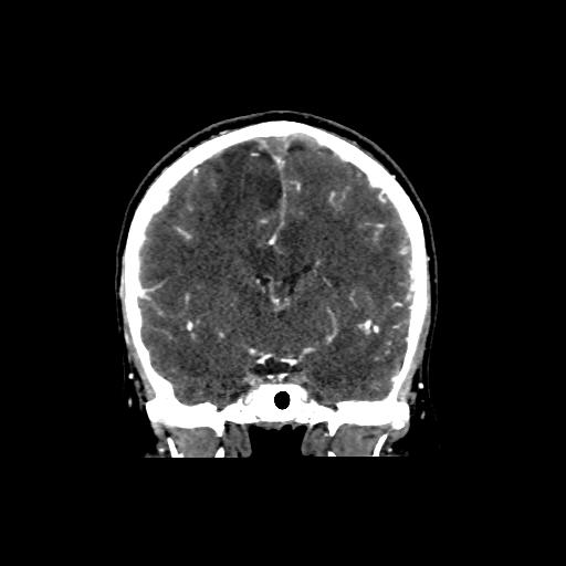 File:Cerebral venous throbmosis - hemorrhagic venous infarction (Radiopaedia 87318-103613 Coronal CT venogram 15).jpg