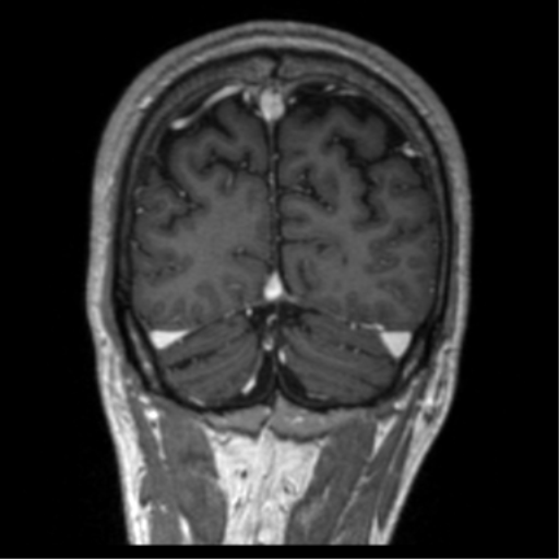 Cerebral venous thrombosis (Radiopaedia 38392-40469 Coronal T1 C+ 15).png