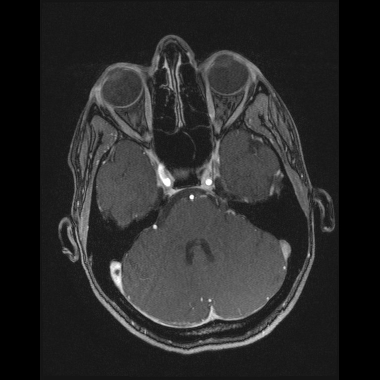 Cerebral venous thrombosis (Radiopaedia 45678-49854 Axial MRV 18).jpg