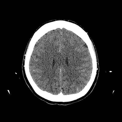 Cerebral venous thrombosis with venous hemorrhagic infarct (Radiopaedia 90354-107660 Axial with contrast 111).jpg