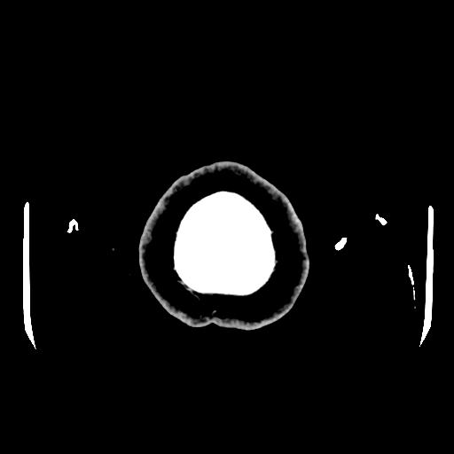 Cerebral venous thrombosis with venous hemorrhagic infarct (Radiopaedia 90354-107660 Axial with contrast 170).jpg
