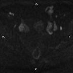 File:Cervical adenocarcinoma (Radiopaedia 65011-73985 Axial DWI 57).jpg