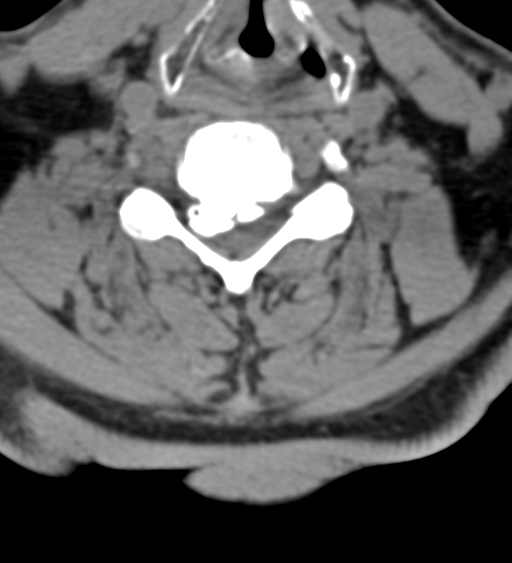File:Cervical canal stenosis due to ossification of the posterior longitudinal ligament (Radiopaedia 47260-51823 Axial non-contrast 37).png