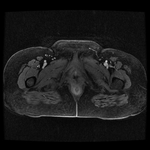 Cervical carcinoma (Radiopaedia 70924-81132 Axial T1 C+ fat sat 196).jpg