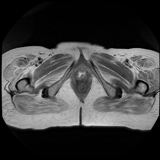 File:Cervical carcinoma (Radiopaedia 88010-104555 Axial T2 21).jpg