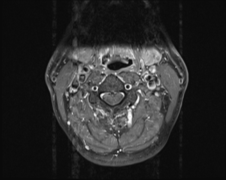 File:Cervical disc extrusion (Radiopaedia 53950-60077 Axial T1 C+ fat sat 5).jpg