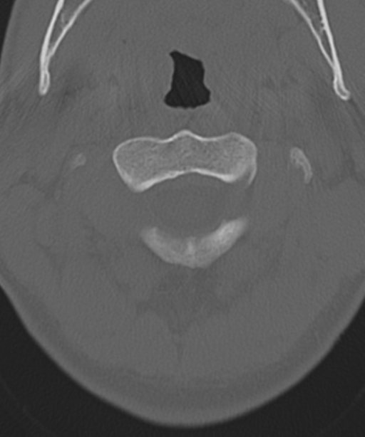 Cervical intercalary bone (Radiopaedia 35211-36748 Axial bone window 17).png
