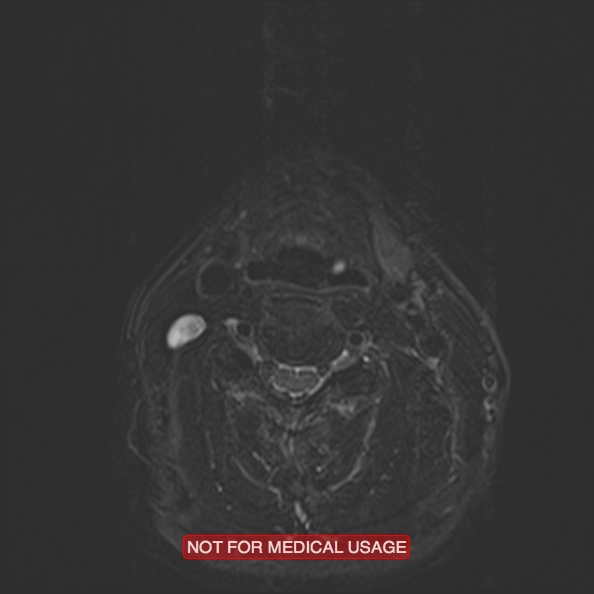 Cervical nerve schwannoma (Radiopaedia 27964-28221 C 33).jpg