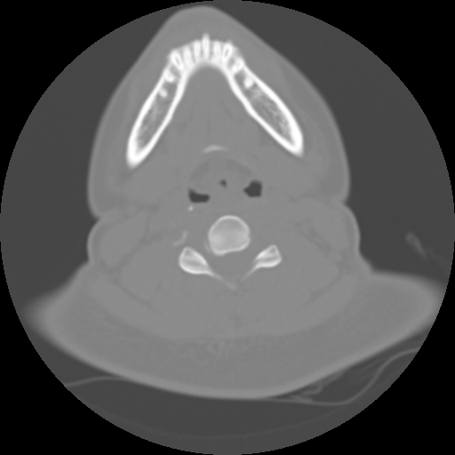 Cervical rib (Radiopaedia 71110-81363 Axial non-contrast 32).jpg