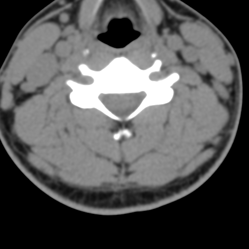 Cervical schwannoma (Radiopaedia 57979-64974 Axial non-contrast 36).png