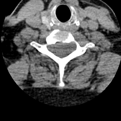 File:Cervical spinal neurofibroma in a patient with NF1 (Radiopaedia 58344-65464 Axial non-contrast 57).jpg