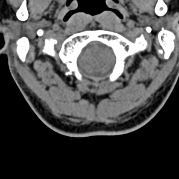Cervical spondylodiscitis (Radiopaedia 28057-29489 Axial non-contrast 12).jpg