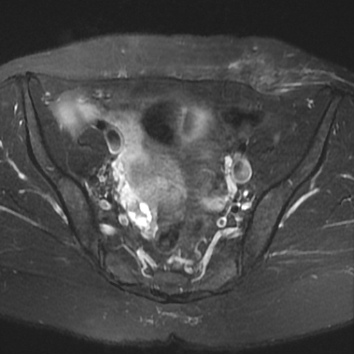 File:Cesarian section scar endometriosis (Radiopaedia 66520-75799 Axial T2 fat sat 8).jpg