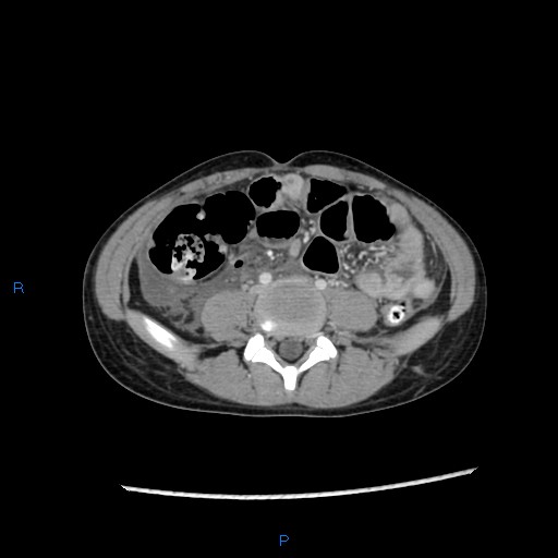 File:Chance fracture with duodenal and pancreatic lacerations (Radiopaedia 43477-46864 A 35).jpg