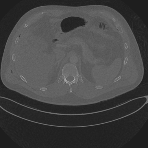 Chest multitrauma - aortic injury (Radiopaedia 34708-36147 Axial bone window 295).png