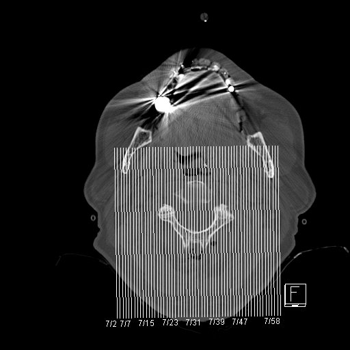 Chiari I malformation with a symptomatic syrinx of the posterolateral medulla oblongata (Radiopaedia 42573-45707 A 1).jpg