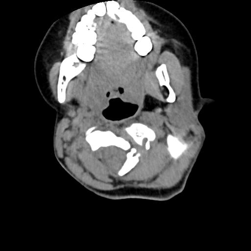 Chiari I with syrinx and skull base anomalies (Radiopaedia 89444-106412 Axial non-contrast 57).jpg
