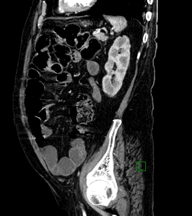 Cholangiocarcinoma with cerebral metastases (Radiopaedia 83519-98629 F 37).jpg
