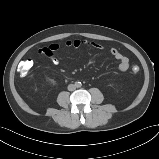 Cholecystitis with focal perforation and hepatic abscess (Radiopaedia 37189-38945 Axial non-contrast 48).png