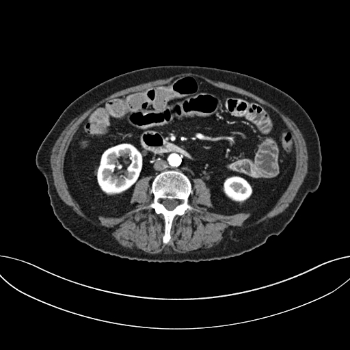 Cholecystoduodenal fistula due to calculous cholecystitis with gallstone migration (Radiopaedia 86875-103077 A 38).jpg