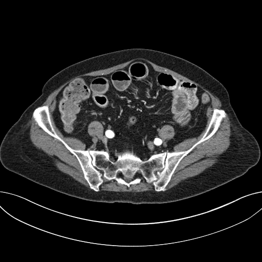Cholecystoduodenal fistula due to calculous cholecystitis with gallstone migration (Radiopaedia 86875-103077 A 52).jpg