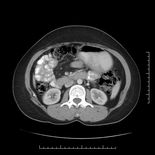 File:Choledochal cyst with chronic calcific pancreatitis (Radiopaedia 18245-18061 A 18).png