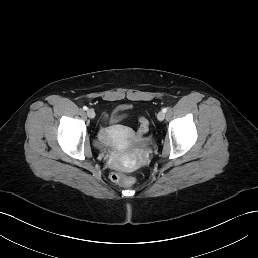 File:Choledocholithiasis after recent cholecystectomy (Radiopaedia 60929-68737 Axial 50).jpg