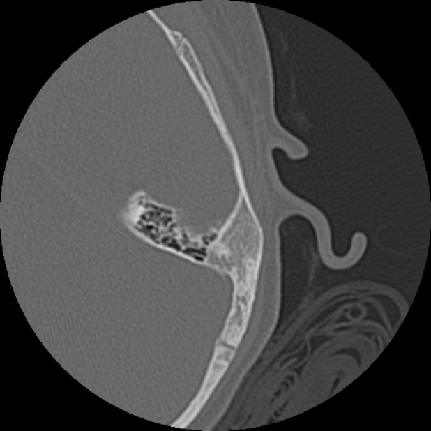 Cholesteatoma (Radiopaedia 73023-83750 Axial Left ear 74).jpg
