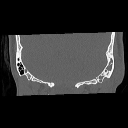 File:Cholesteatoma (Radiopaedia 84960-100474 Coronal bone window 60).jpg