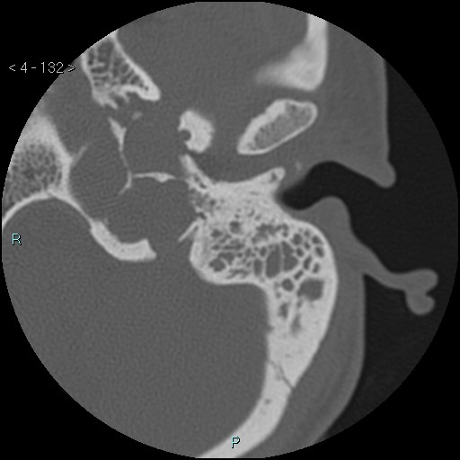 File:Cholesterol granuloma of the petrous apex (Radiopaedia 64358-73141 Axial bone window 64).jpg