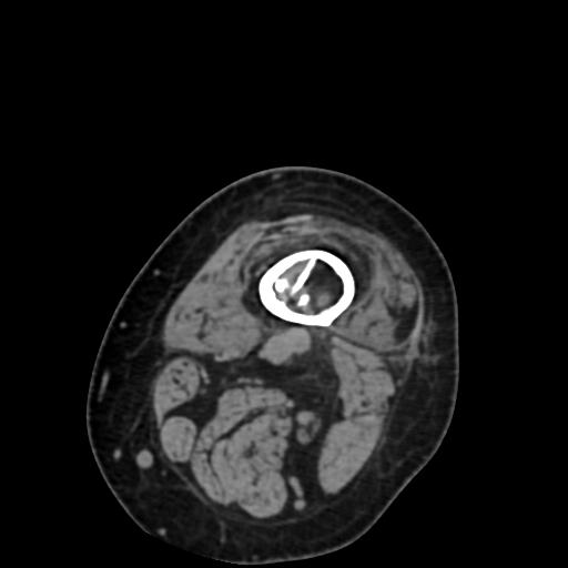 Chondrosarcoma - femur (Radiopaedia 64187-72954 Axial non-contrast 9).jpg