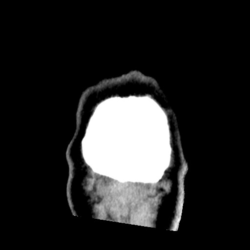File:Chondrosarcoma - sphenoid wing (Radiopaedia 58259-67828 Coronal non-contrast 34).jpg