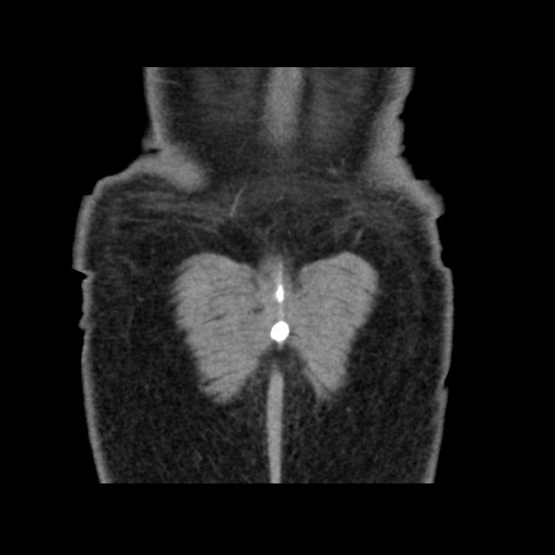 Chondrosarcoma of iliac wing (Radiopaedia 63861-72599 Coronal non-contrast 108).jpg