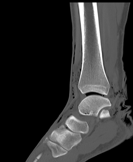 Chopart fracture (Radiopaedia 35347-36851 Sagittal bone window 29).jpg