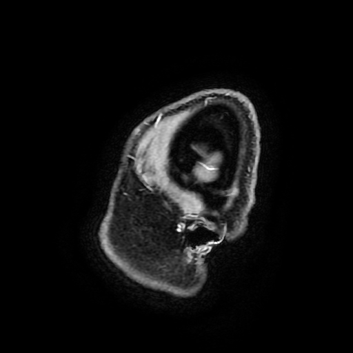 Chordoid glioma of third ventricle (Radiopaedia 91612-109340 F 194).jpg