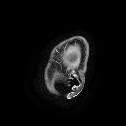Chordoid glioma of third ventricle (Radiopaedia 91612-109340 F 201).jpg