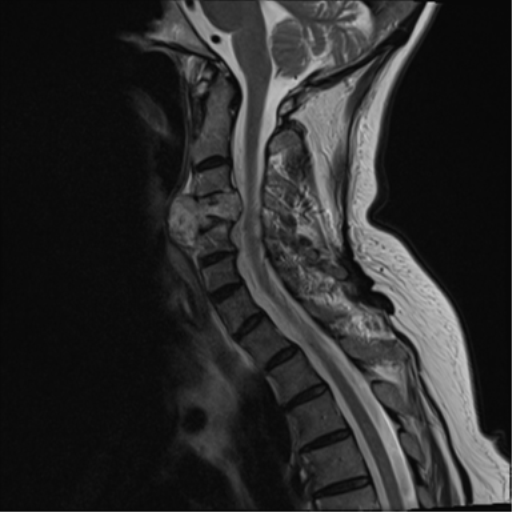 File:Chordoma (C4 vertebra) (Radiopaedia 47561-52189 Sagittal T2 8).png