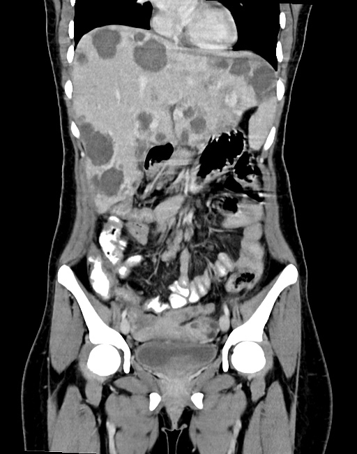Choriocarcinoma liver metastases (Radiopaedia 74768-85766 B 45).jpg