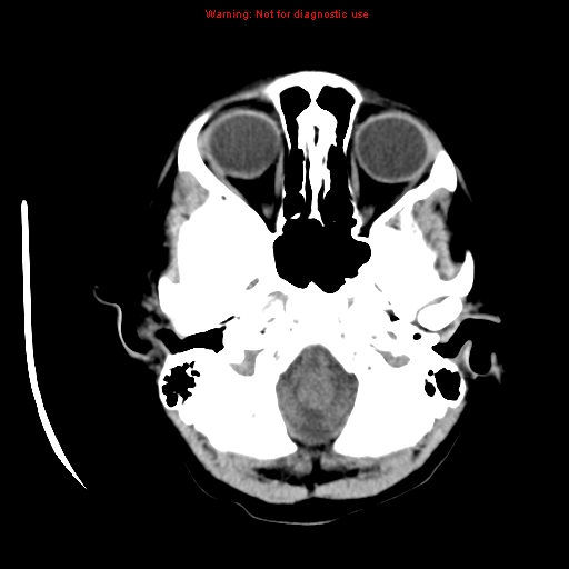 File:Choroid plexus carcinoma - recurrent (Radiopaedia 8330-9168 Axial non-contrast 3).jpg